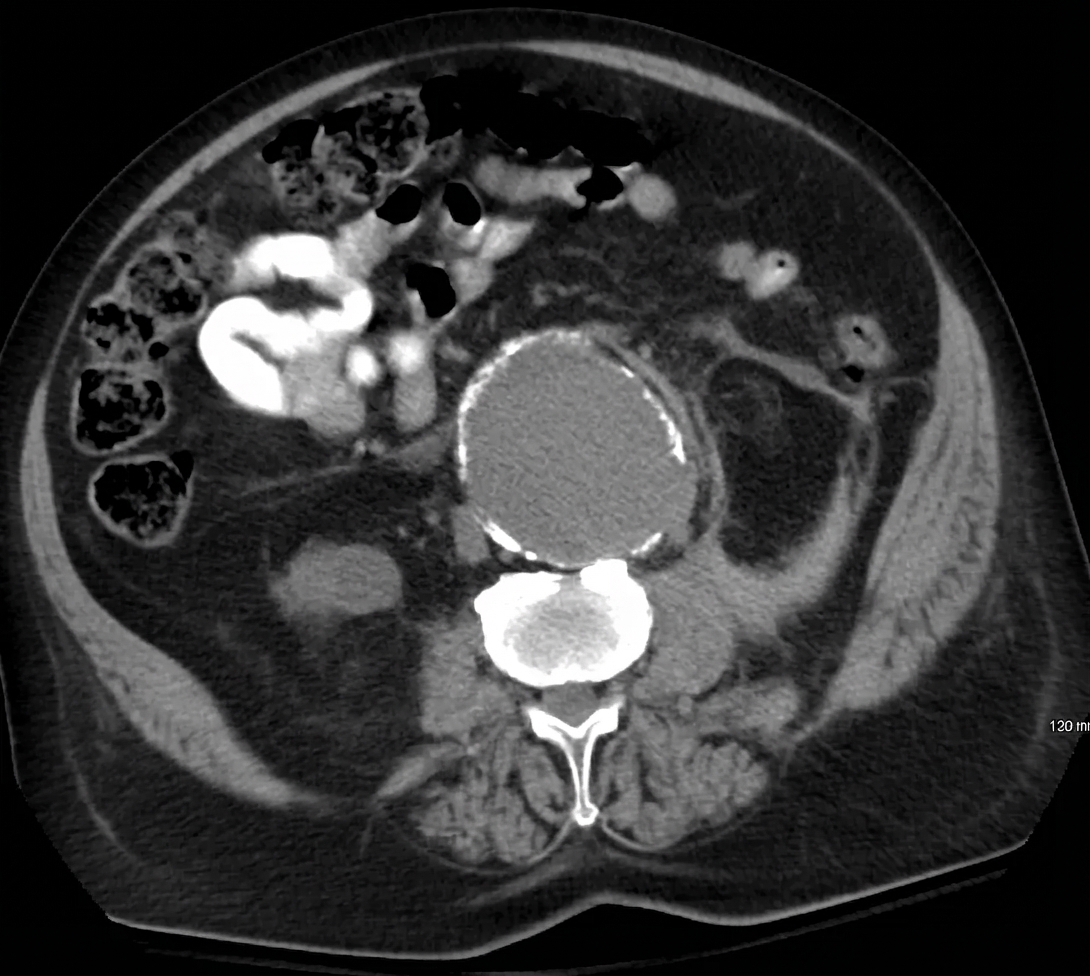 Axial abdominal CT scan showing an abdominal aortic aneurysm.